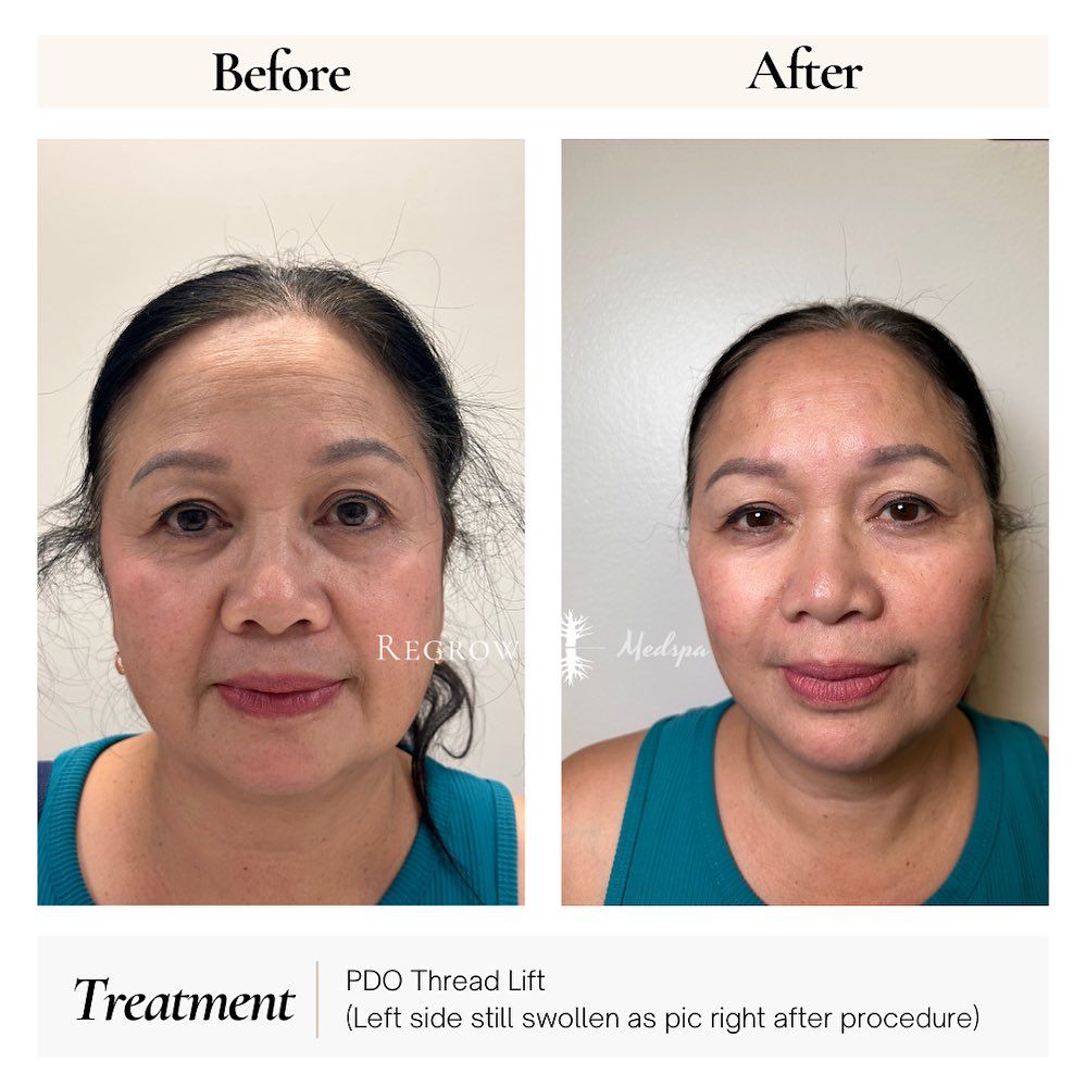 Before/after facial comparison of a woman, likely after a PDO thread lift. She has less visible wrinkles.