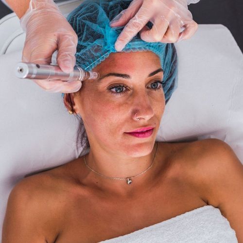 Woman undergoing micro-needling facial treatment, laying on white linens.  A gloved hand holds device to skin.