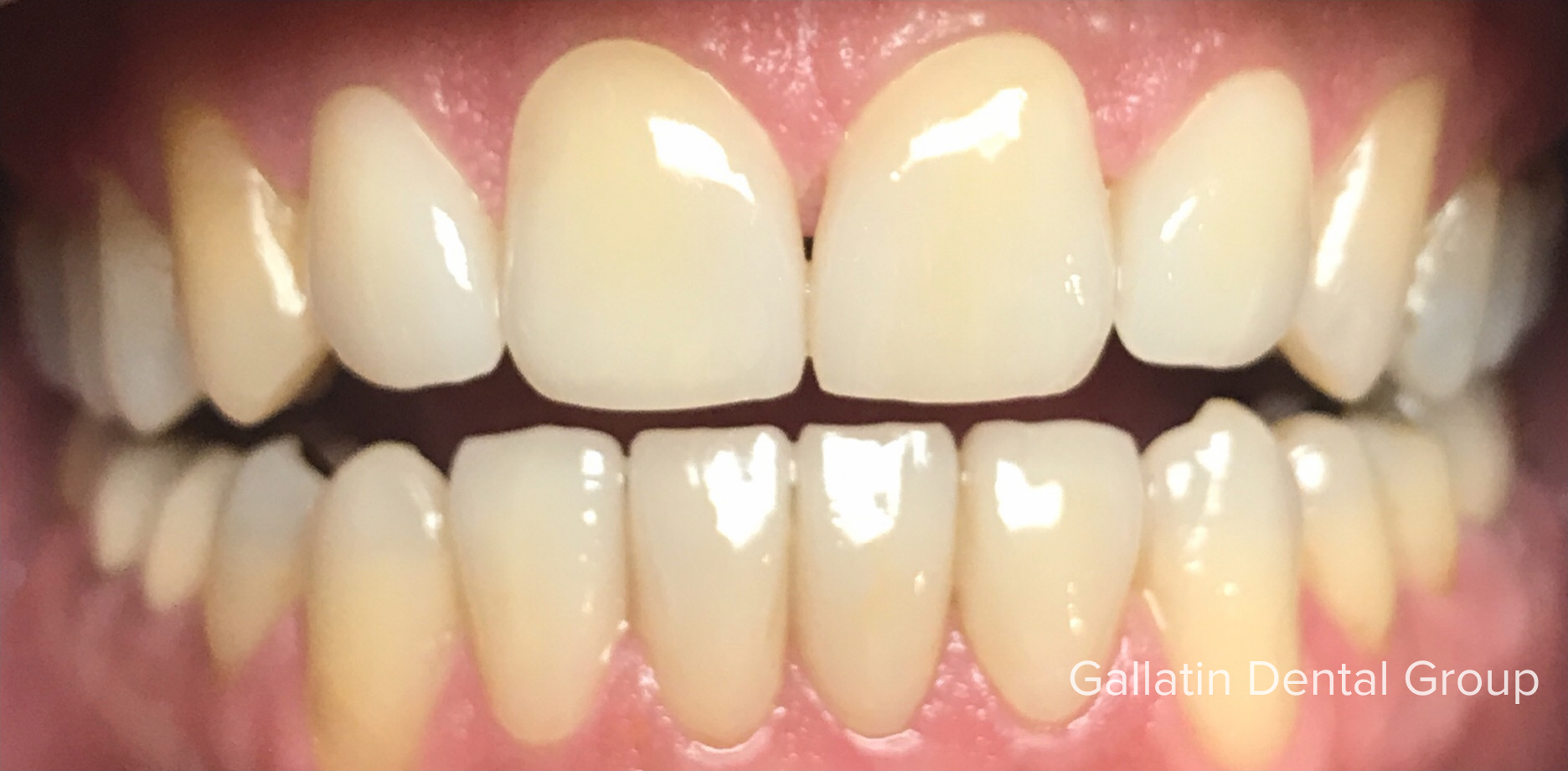 A close up of a person 's teeth with white teeth.