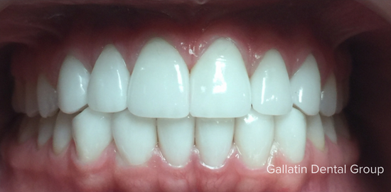 A close up of a person 's teeth taken by the callatri dental group