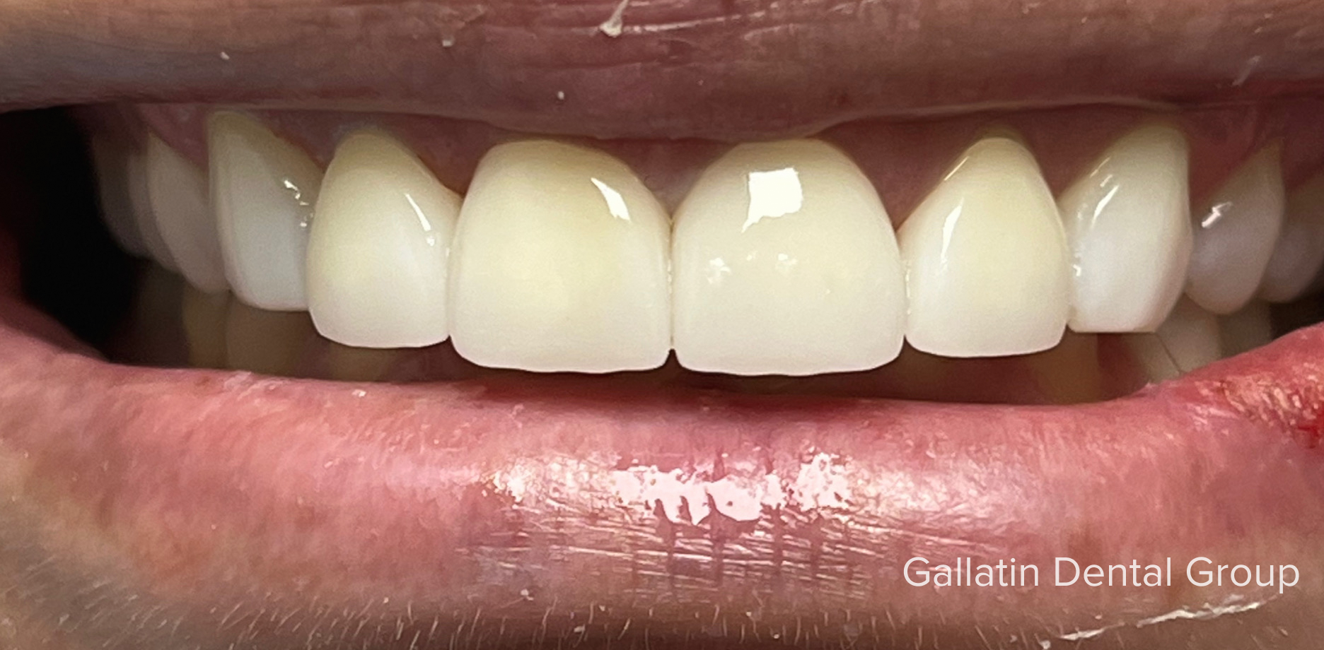 A close up of a person 's mouth with white teeth.