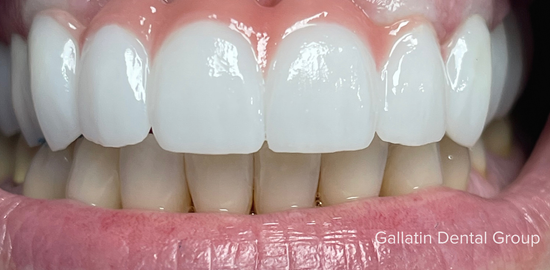 A close up of a person 's teeth with white teeth.