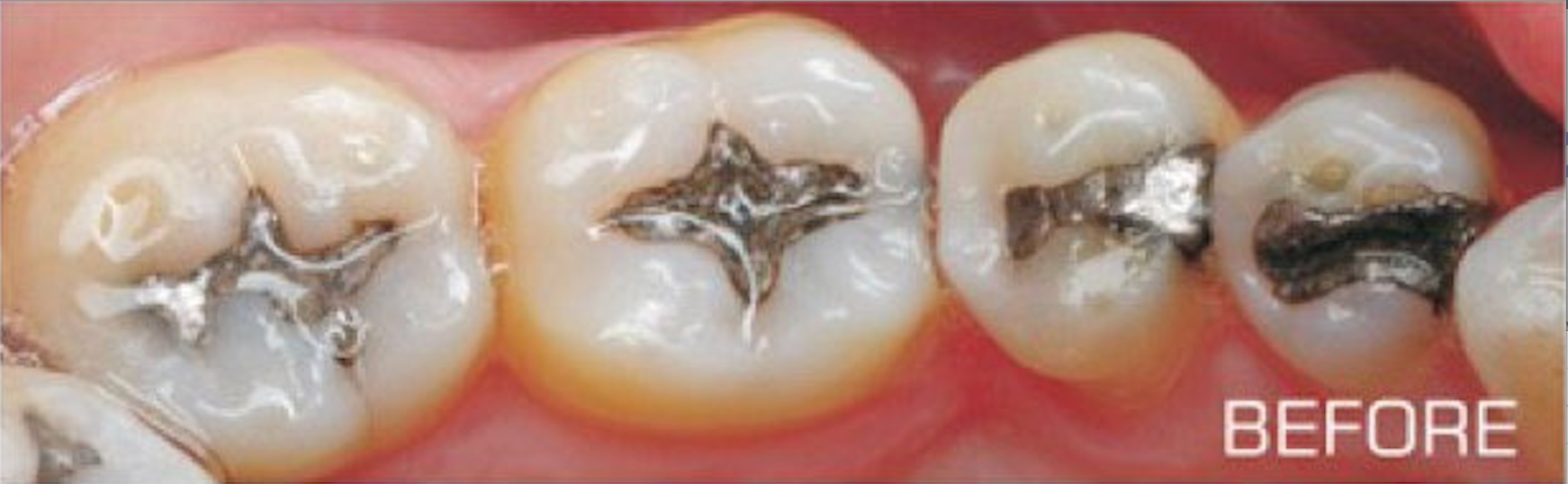 A before and after picture of a person 's teeth