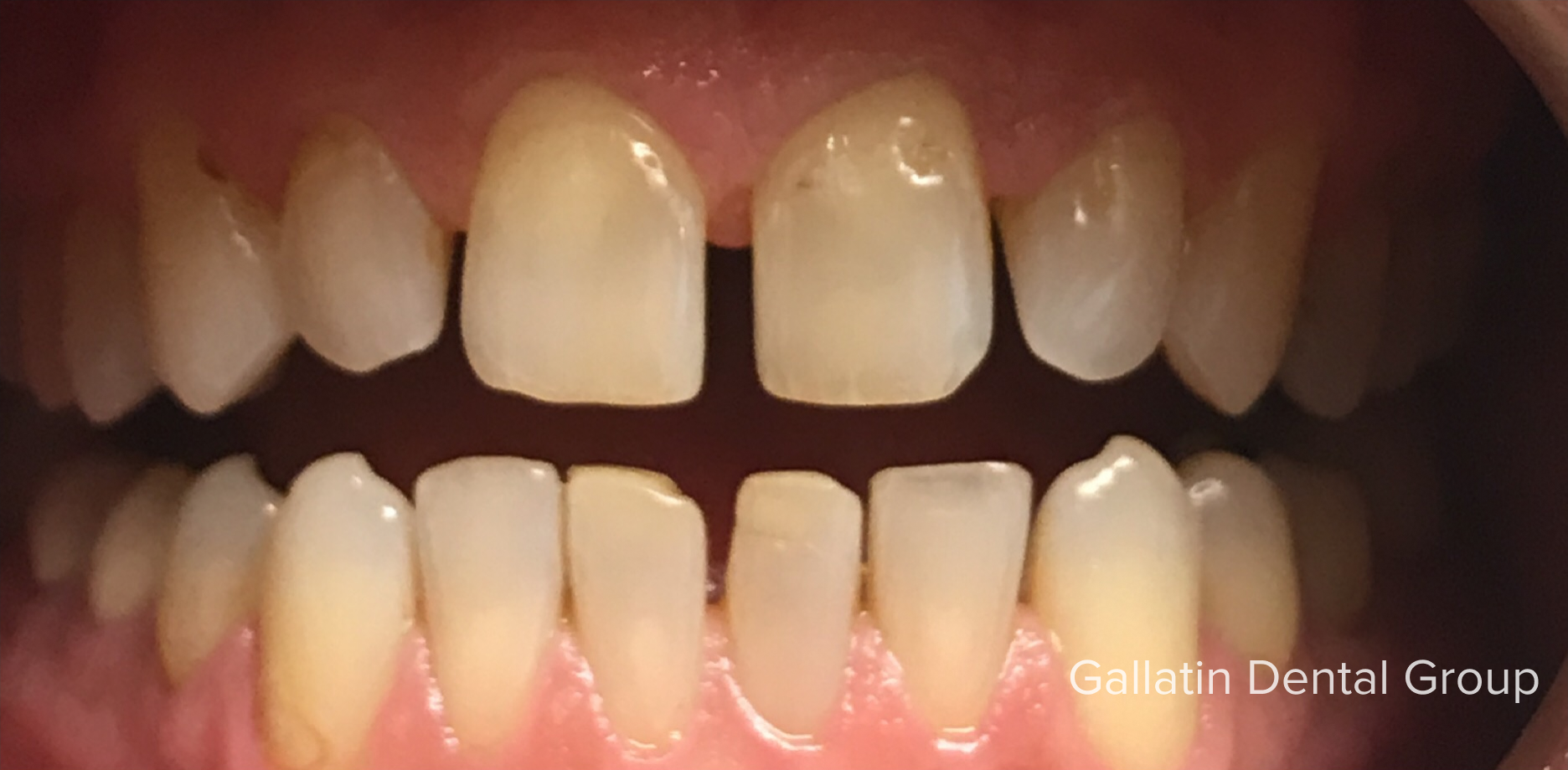 A close up of a person 's teeth with a broken tooth.