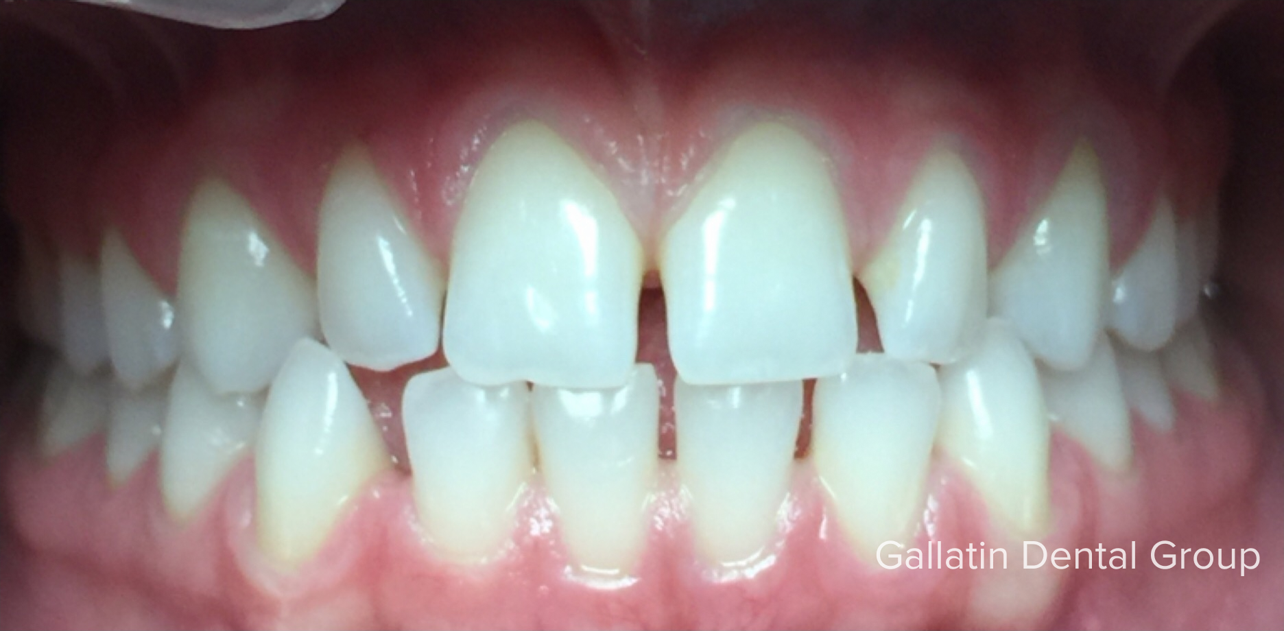 A close up of a person 's teeth with a missing tooth