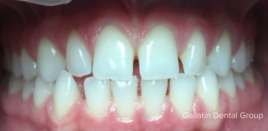 A close up of a person 's teeth with a missing tooth