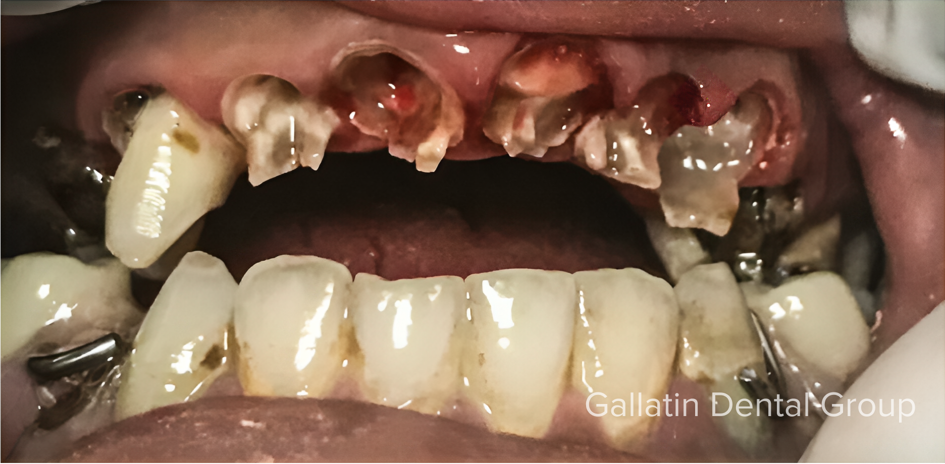 A close up of a person 's mouth with a lot of teeth missing