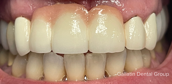 A close up of a person 's teeth with a smile.