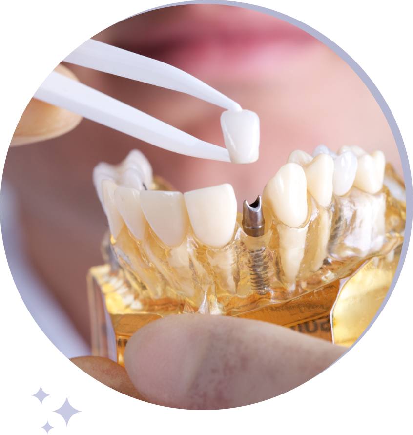 dental implants