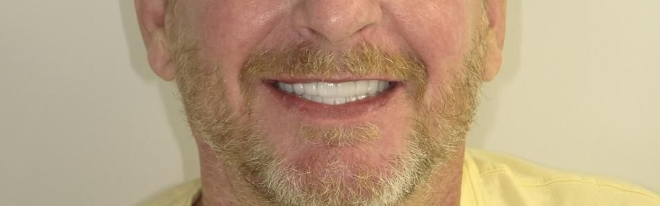 Close-up of a woman's mouth after a dental procedure, showing new, white teeth.