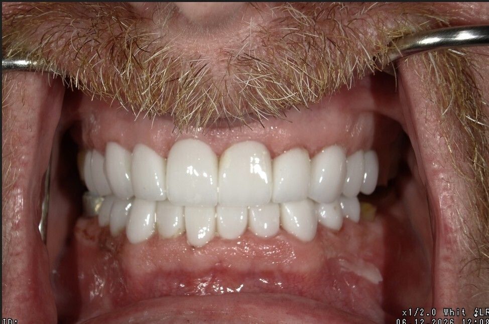 Close-up of a man’s mouth showing bright white teeth and gums in a smile