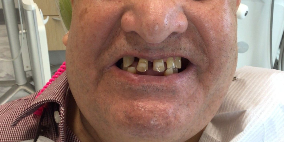 Close-up of a woman's smiling face, showing a set of bright white teeth, after a dental procedure.