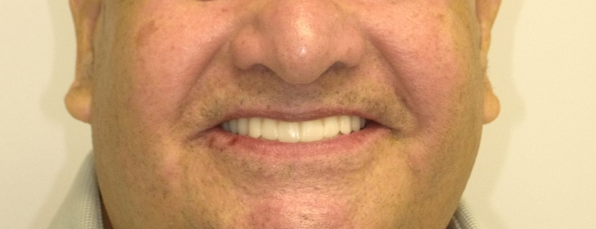 Close-up of person's mouth with teeth before cosmetic work; discolored and slightly uneven teeth.