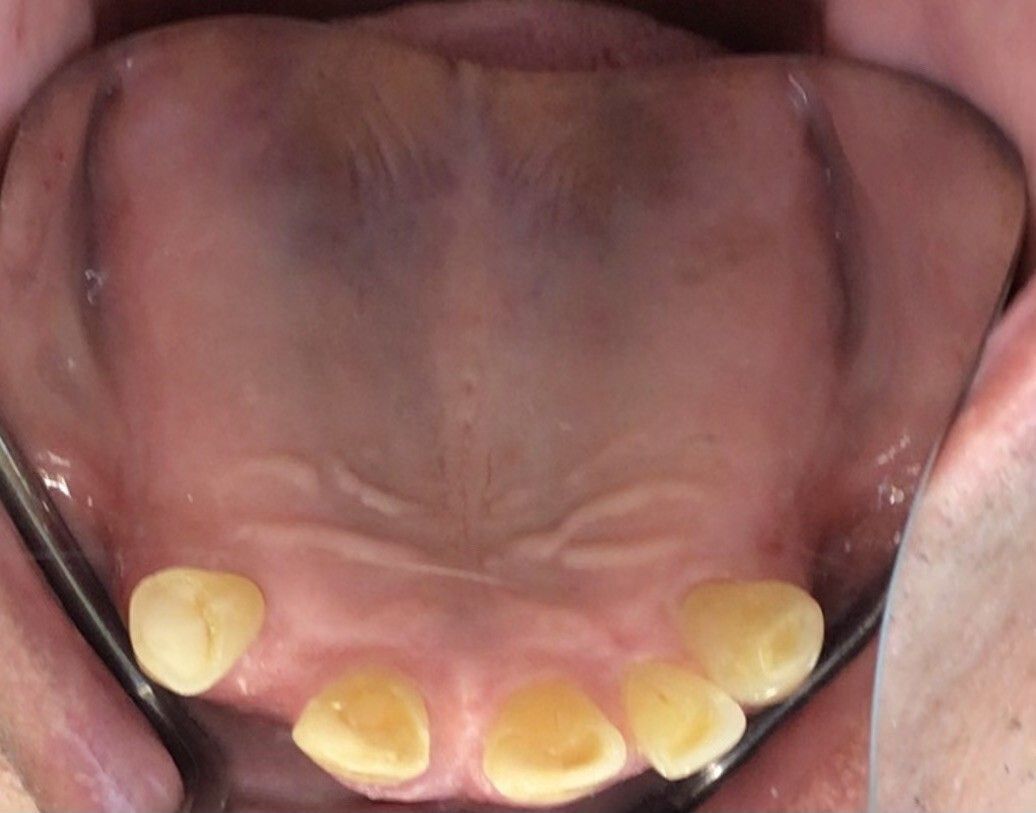 Open mouth showing lower front teeth and gums with yellow discoloration