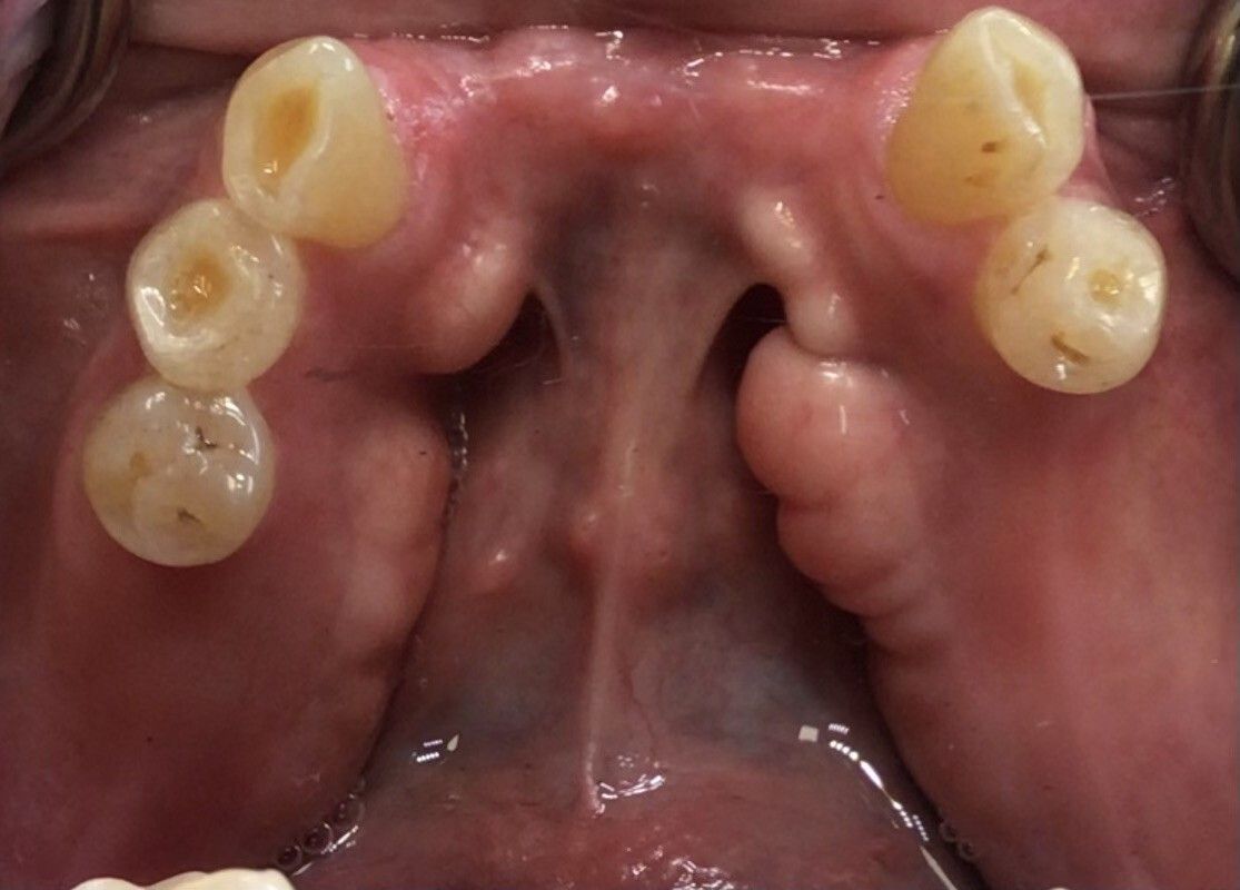 Upper view of the inside of a mouth showing the upper teeth and palate with missing front teeth