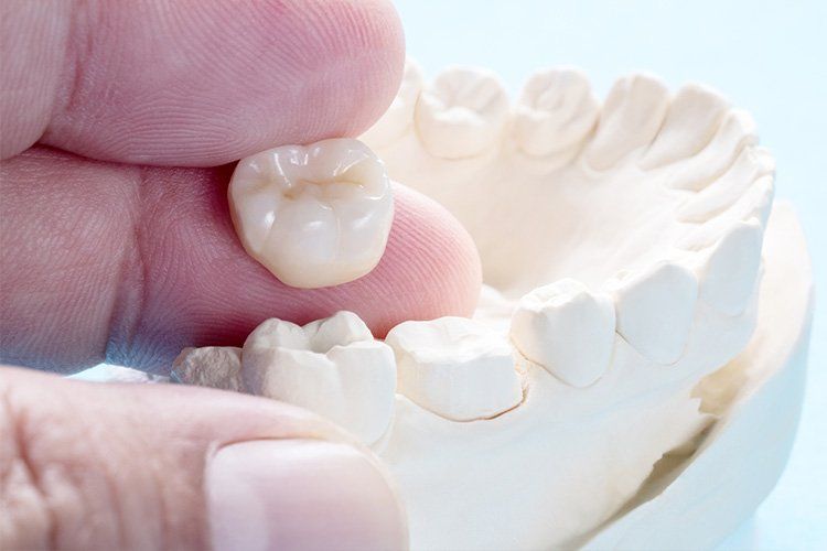 Hand holding a porcelain dental crown next to a plaster dental model.