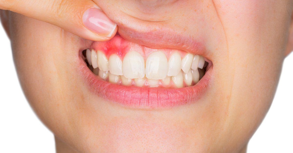 Person showing inflamed, red gums above teeth, a sign of possible gum disease.