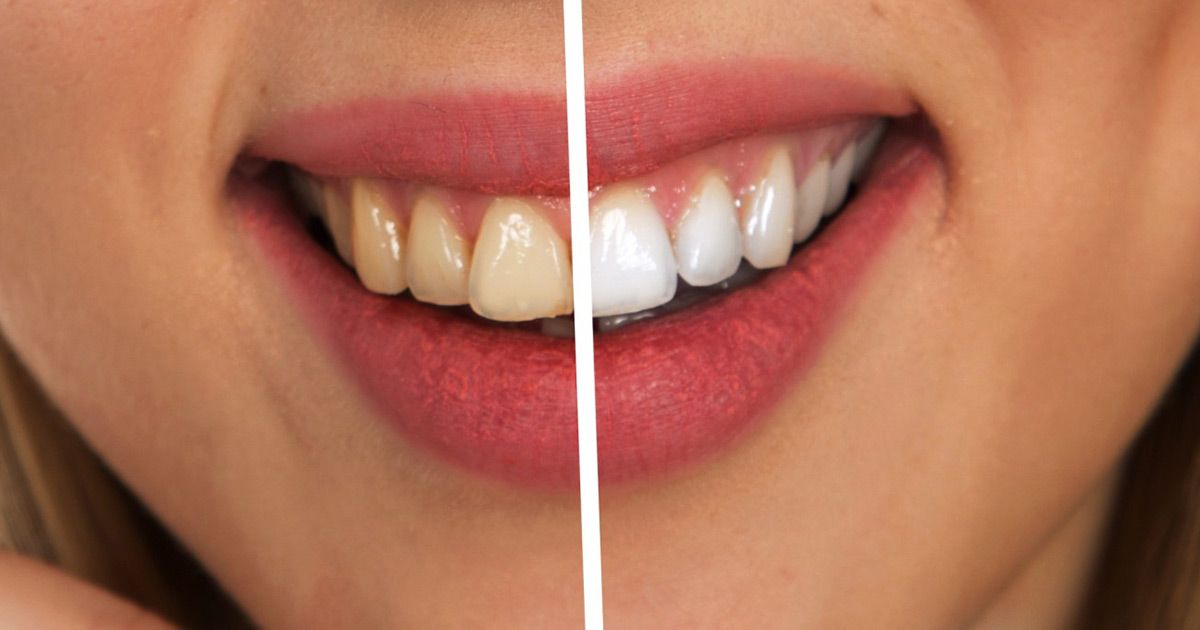 Smiling mouth with a before/after comparison of teeth whitening; left side shows stained teeth, right side, white.