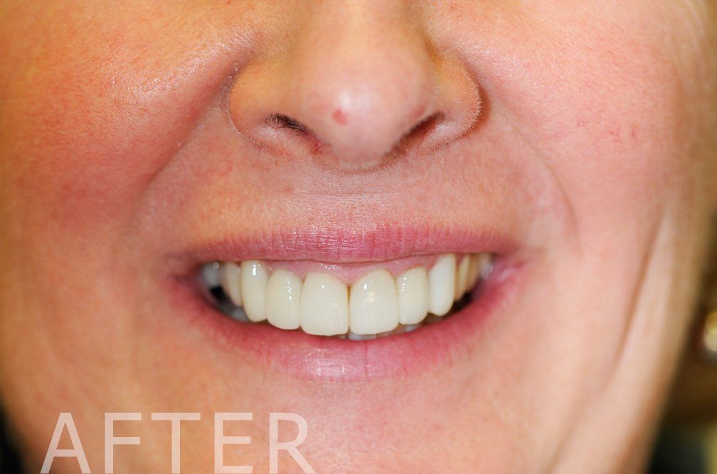 Close-up of a smiling mouth showing bright white teeth, with “AFTER” text in the corner