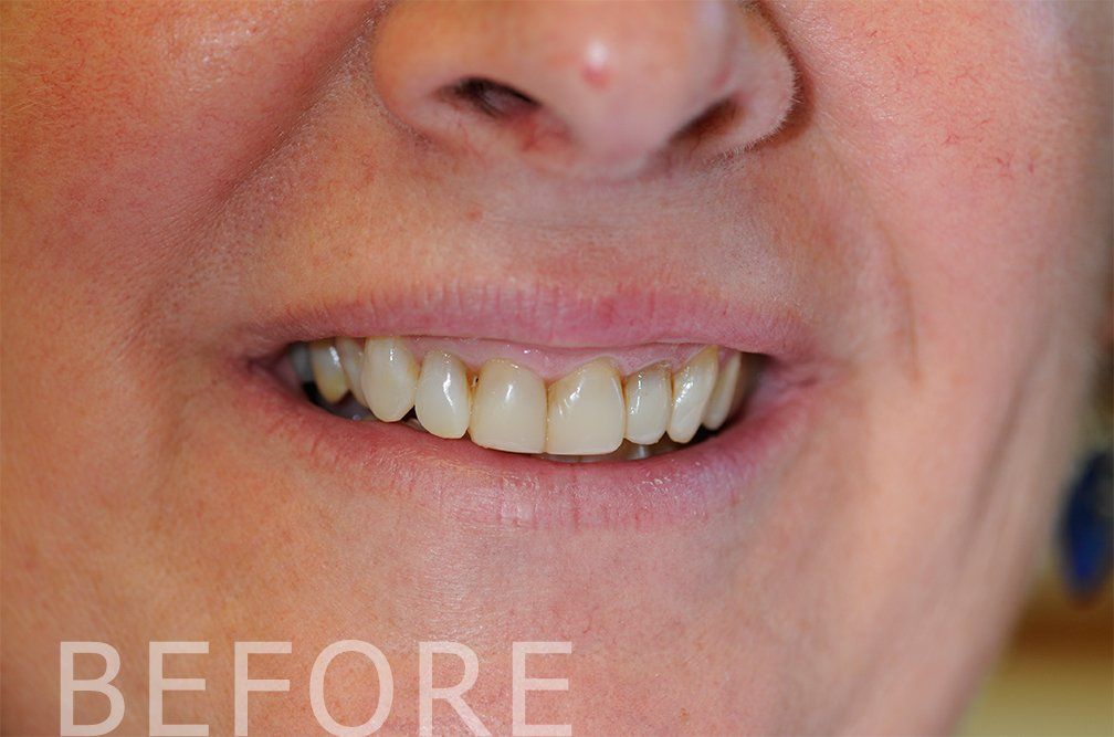 Close-up of a smiling mouth with yellowed teeth, labeled “BEFORE”