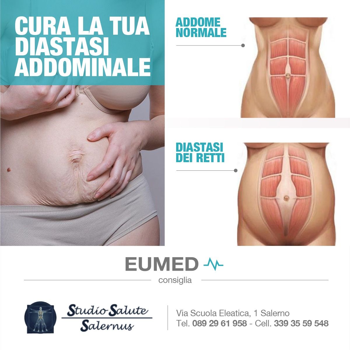 diastasi addominale, fisioterapia dermatofunzionale,