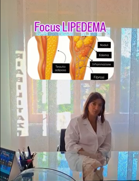 Il lipedema è una malattia cronica e progressiva del tessuto adiposo, che causa un accumulo anomalo
