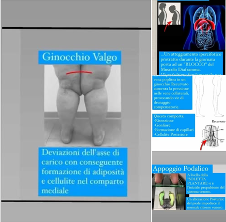 Il lipedema può provocare una deviazione a X delle gambe (ginocchio valgo) a causa dell'accumulo di 