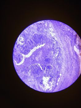 Inverted Papilloma &ndash; ENT care at Gangnam Yonsei ENT Clinic in Gangnam, Seoul