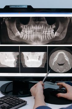 Can a Dental Implant Cause Sinusitis? &ndash; ENT care at Gangnam Yonsei ENT Clinic in Gangnam, Seoul