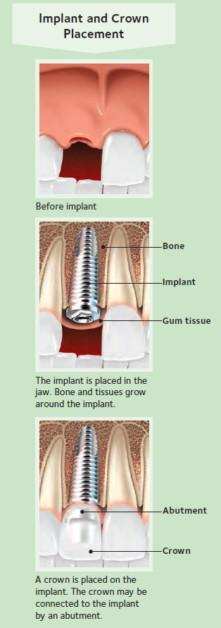 Implant And Crown Placement — Hudsonville, MI — Hudsonville Family Dentistry Implant And Crown Placement — Hudsonville, MI — Hudsonville Family Dentistry