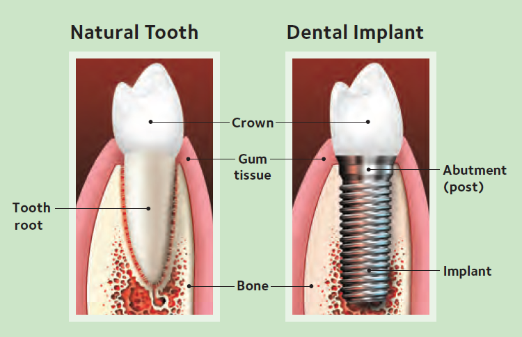 Natural Tooth And Dental Implant — Hudsonville, MI — Hudsonville Family Dentistry Natural Tooth And Dental Implant — Hudsonville, MI — Hudsonville Family Dentistry