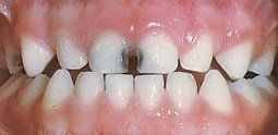 Baby Teeth With Decay — Hudsonville, MI — Hudsonville Family Dentistry Baby Teeth With Decay — Hudsonville, MI — Hudsonville Family Dentistry