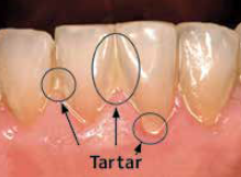 Before Professional Dental Cleaning — Hudsonville, MI — Hudsonville Family Dentistry Before Professional Dental Cleaning — Hudsonville, MI — Hudsonville Family Dentistry