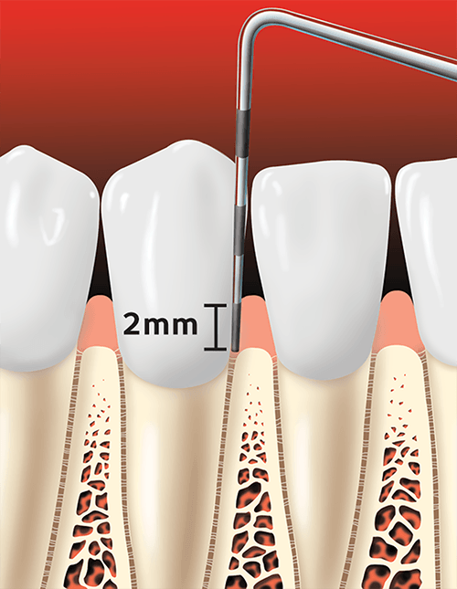 Teeth With 2mm Pocket Depth — Hudsonville, MI — Hudsonville Family Dentistry Teeth With 2mm Pocket Depth — Hudsonville, MI — Hudsonville Family Dentistry