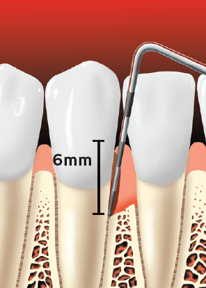 Teeth With 6mm Pocket Depth — Hudsonville, MI — Hudsonville Family Dentistry Teeth With 6mm Pocket Depth — Hudsonville, MI — Hudsonville Family Dentistry