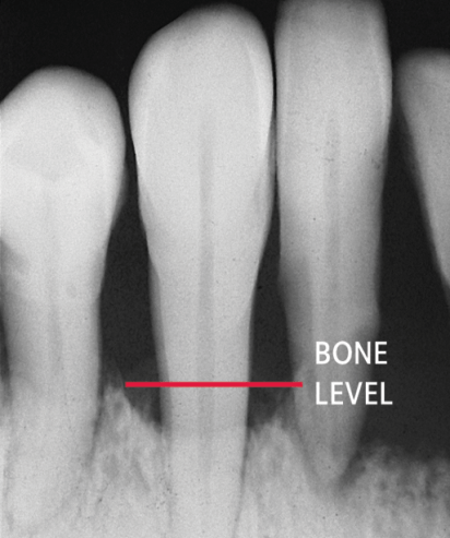Gum Disease — Hudsonville, MI — Hudsonville Family Dentistry Gum Disease — Hudsonville, MI — Hudsonville Family Dentistry