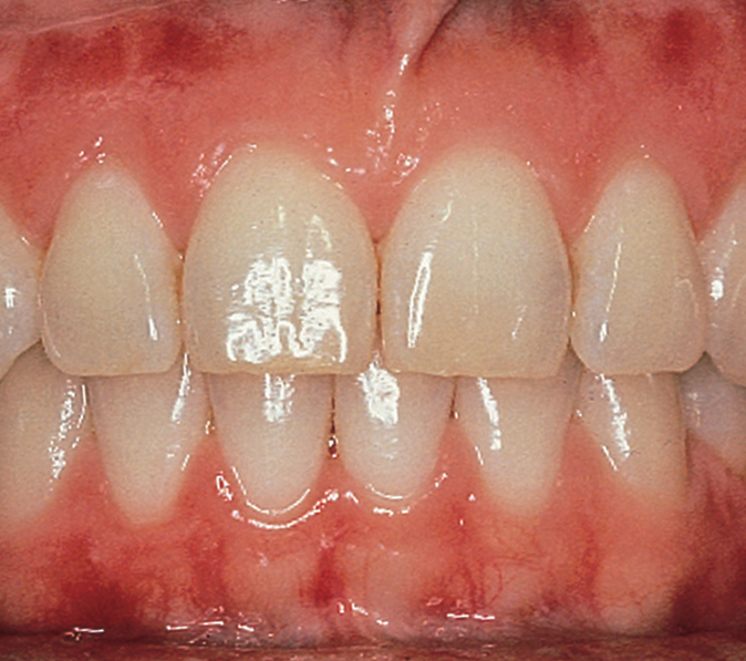 Healthy Gums — Hudsonville, MI — Hudsonville Family Dentistry Healthy Gums — Hudsonville, MI — Hudsonville Family Dentistry