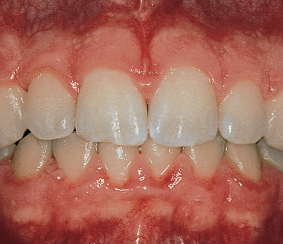 Gingivitis — Hudsonville, MI — Hudsonville Family Dentistry Gingivitis — Hudsonville, MI — Hudsonville Family Dentistry
