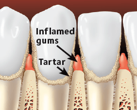 Inflamed Gums And Tartar — Hudsonville, MI — Hudsonville Family Dentistry Inflamed Gums And Tartar — Hudsonville, MI — Hudsonville Family Dentistry