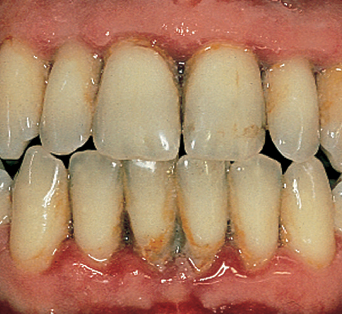 Periodontitis — Hudsonville, MI — Hudsonville Family Dentistry Periodontitis — Hudsonville, MI — Hudsonville Family Dentistry