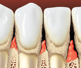 Teeth With Tartar — Hudsonville, MI — Hudsonville Family Dentistry Teeth With Tartar — Hudsonville, MI — Hudsonville Family Dentistry