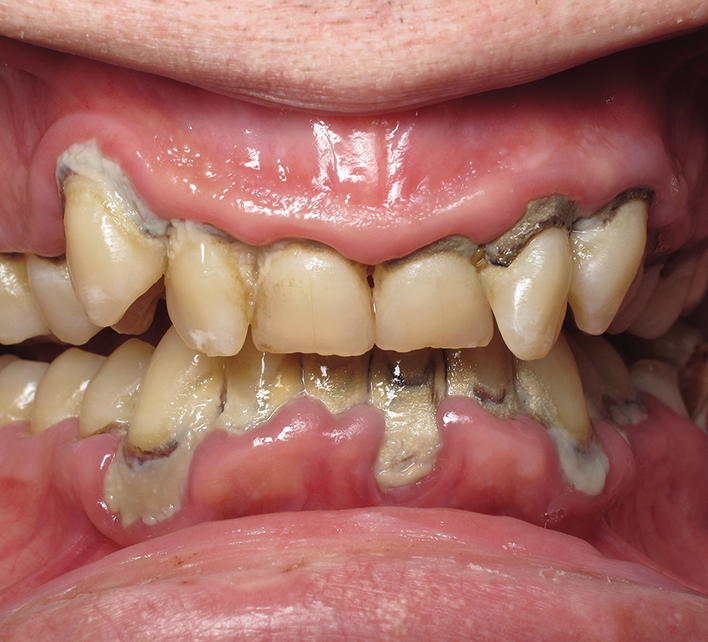 Advanced Periodontitis — Hudsonville, MI — Hudsonville Family Dentistry Advanced Periodontitis — Hudsonville, MI — Hudsonville Family Dentistry