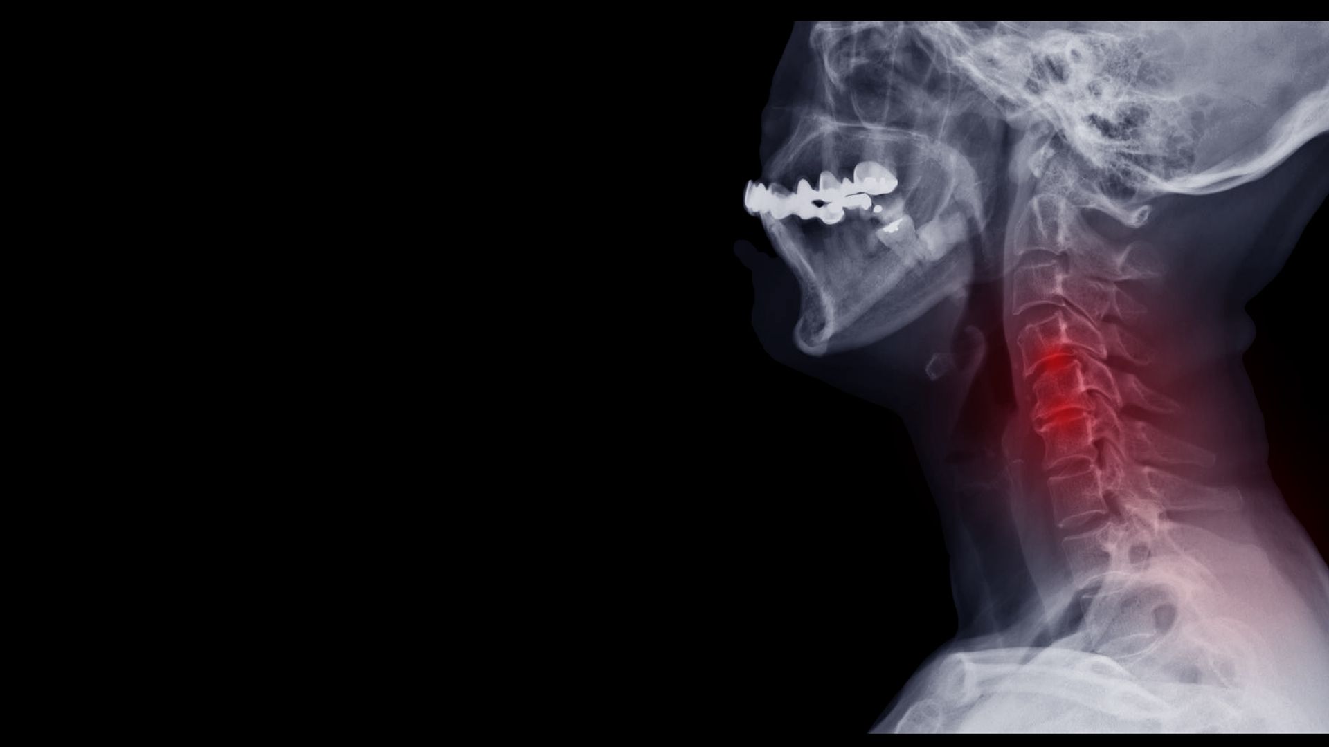 X-ray Of Neck And Cervical Spine Side View — Lumberton, NJ — Advanced Back And Neck Care X-ray Of Neck And Cervical Spine Side View — Lumberton, NJ — Advanced Back And Neck Care
