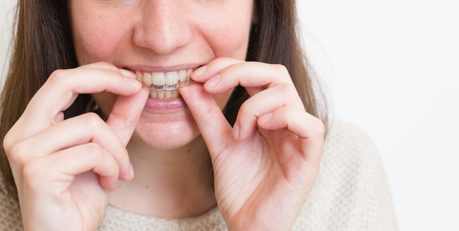 allineatore dentale invisibile