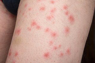 Bed Bugs Infestation - Bed Bug Pest Control Albury-Wodonga, NSW