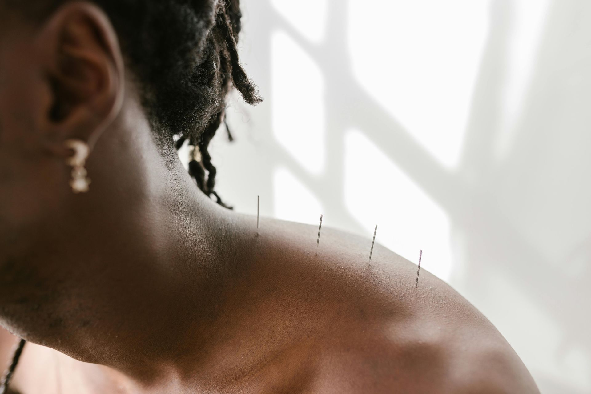Hombro y cuello de una persona con agujas de acupuntura insertadas, iluminados por una luz natural suave.