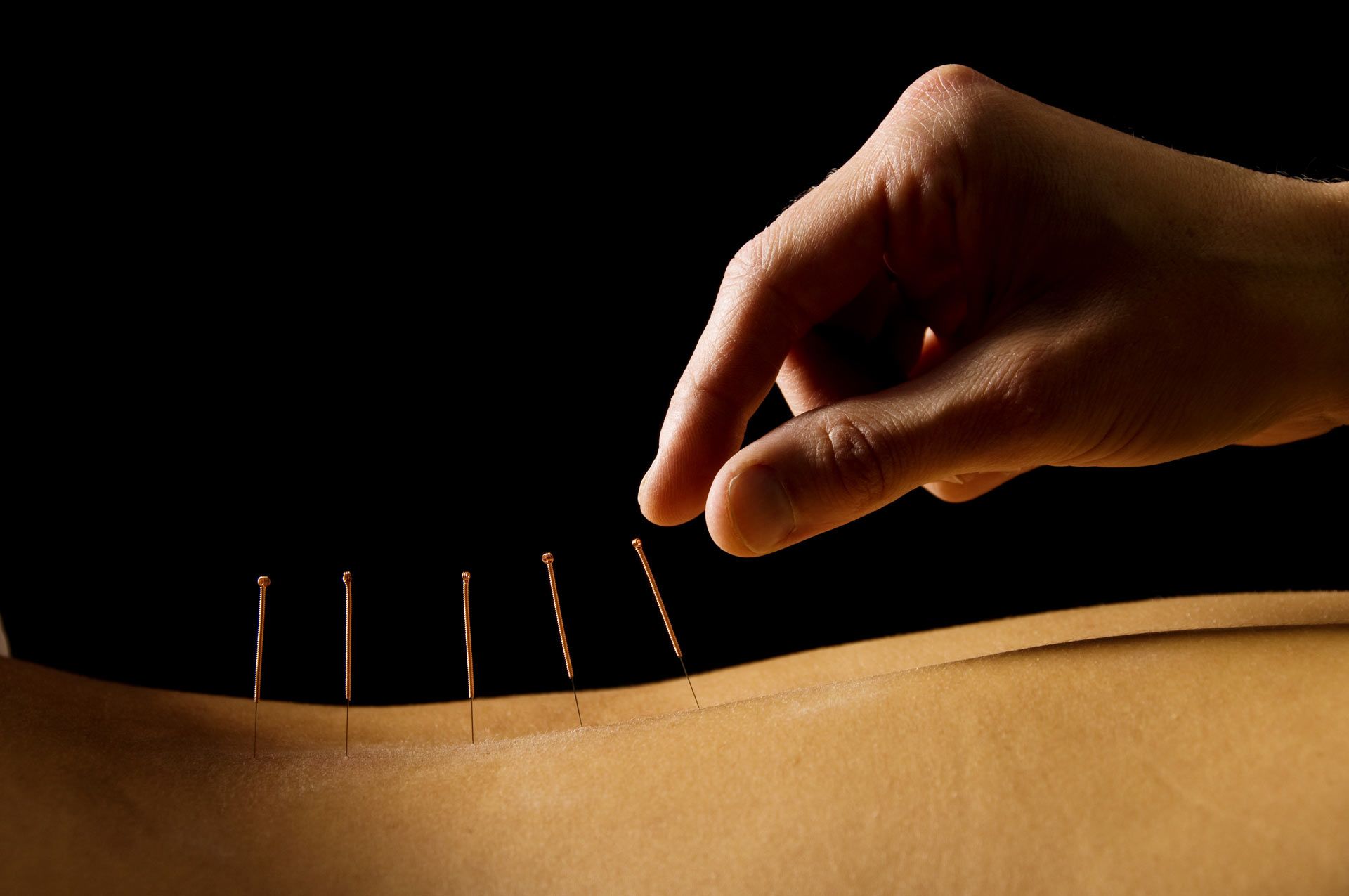 A woman is getting acupuncture on their back