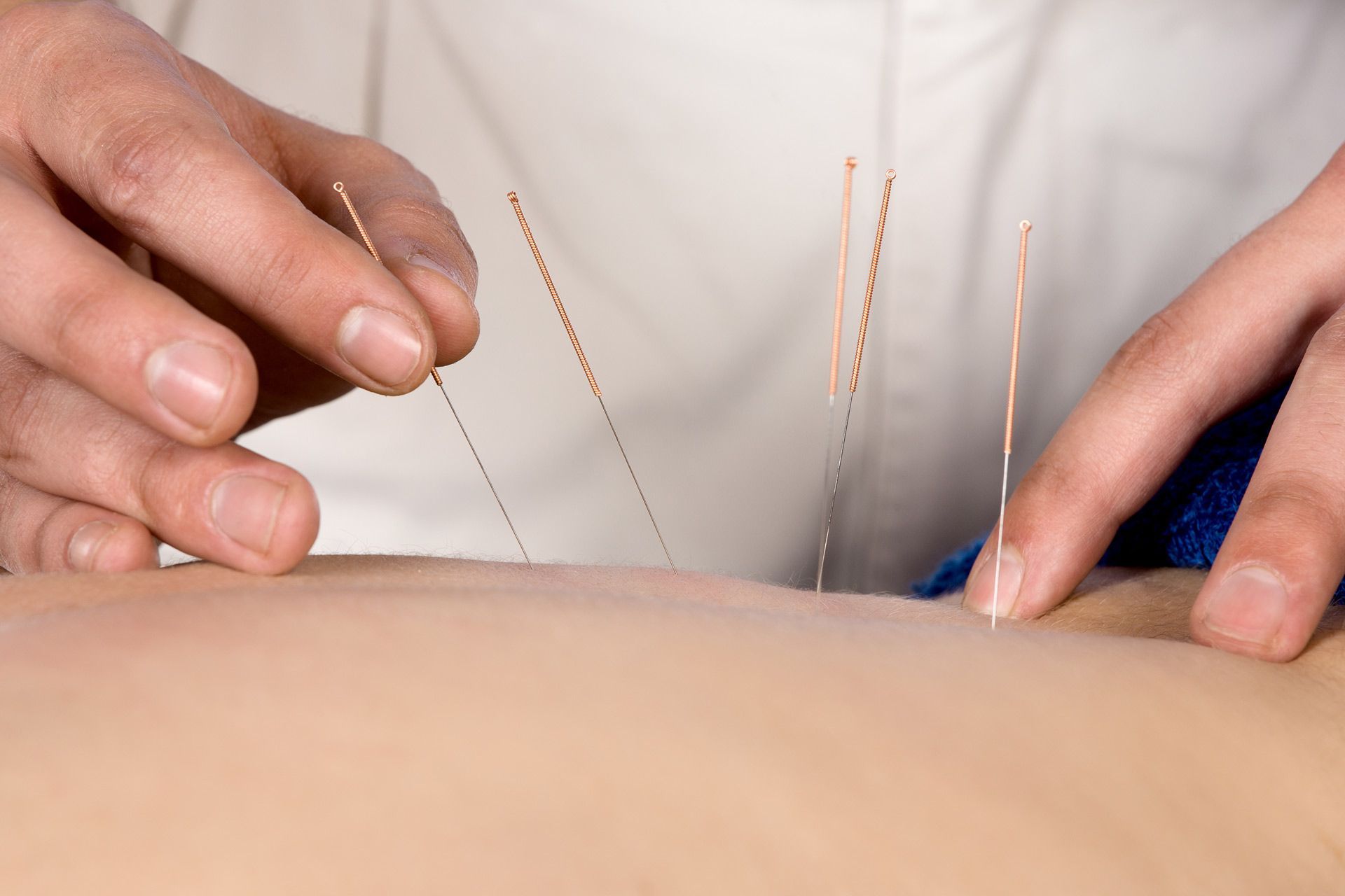A person is getting acupuncture on their back