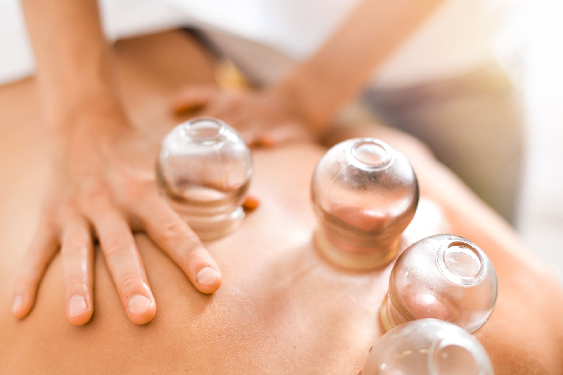 Chinese Cupping