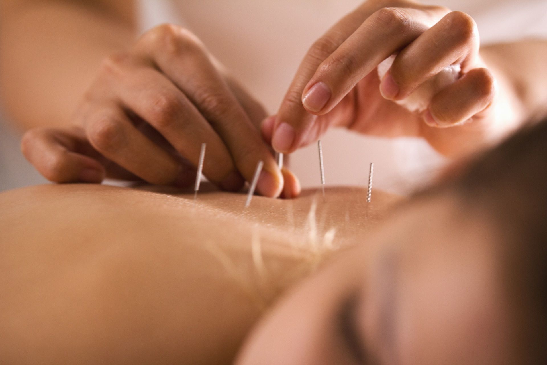Healing Acupuncture